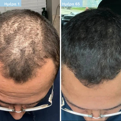 Daynava™ Roll-On για Ανάπτυξη Μαλλιών